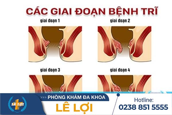 Các giai đoạn bệnh trĩ và cách điều trị